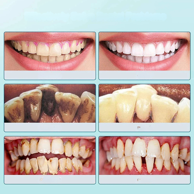 SmilePro Ultrasoon Tandsteenreiniger – Effectieve Plaqueverwijderaar voor Thuis