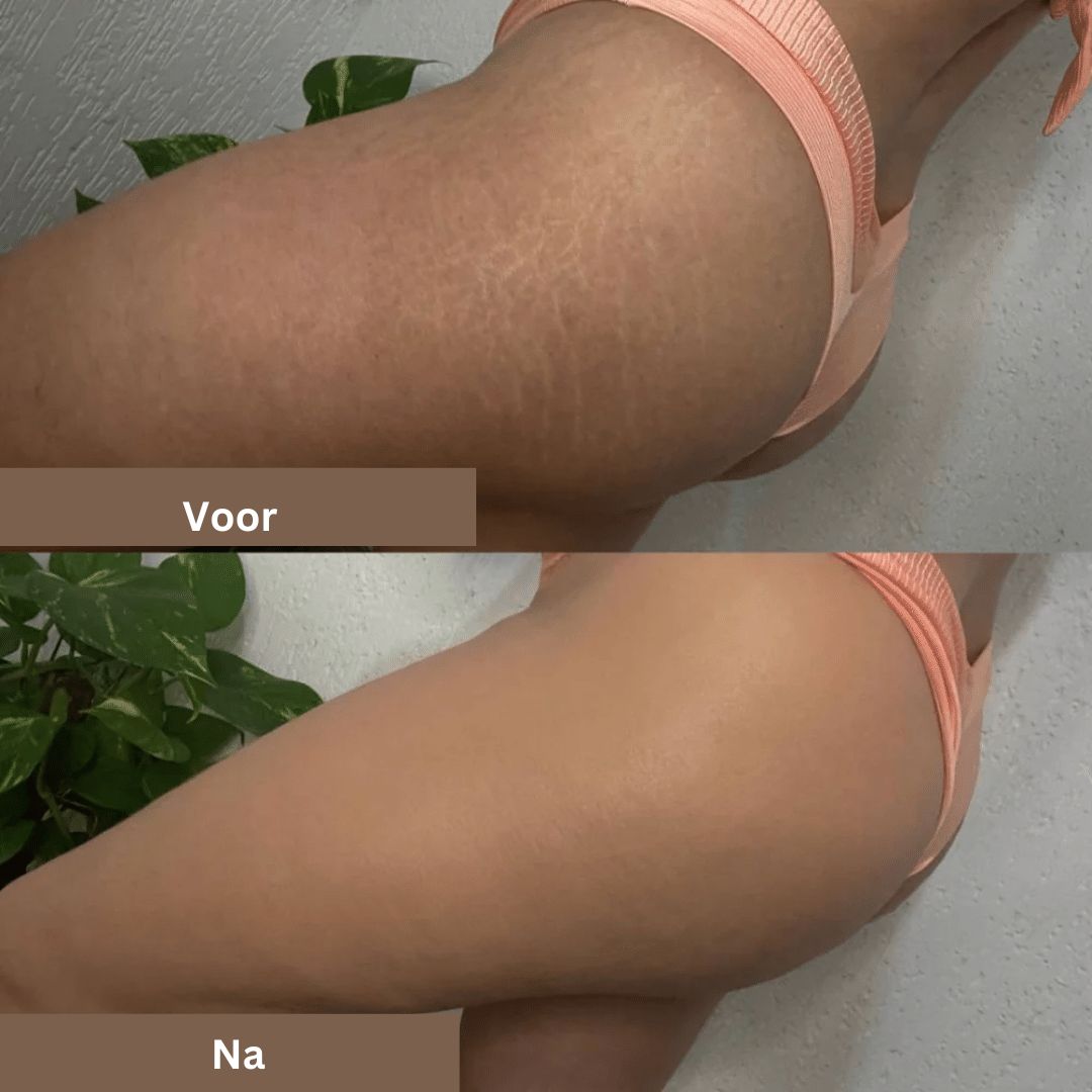 SmoothTone skincare | Voor het bedekken van littekens, aderen, acne, en zonnevlekken