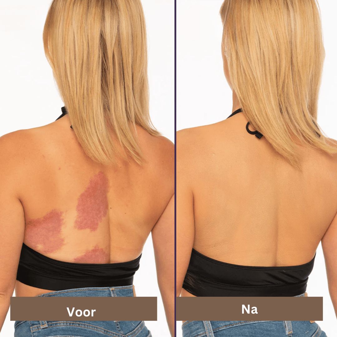 SmoothTone skincare | Voor het bedekken van littekens, aderen, acne, en zonnevlekken