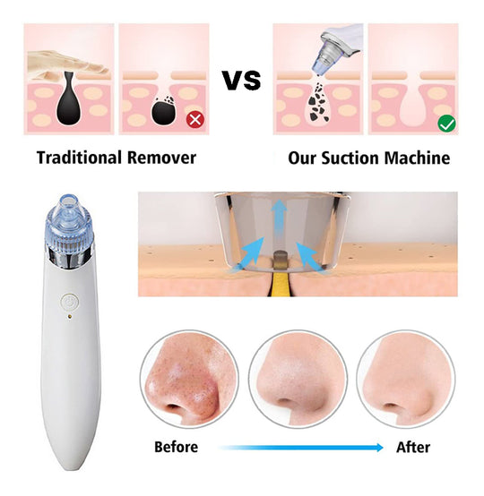 LuxeGlow Elite Blackhead Verwijderapparaat | Oplaadbare 4-in-1 oplossing voor een heldere, stralende huid