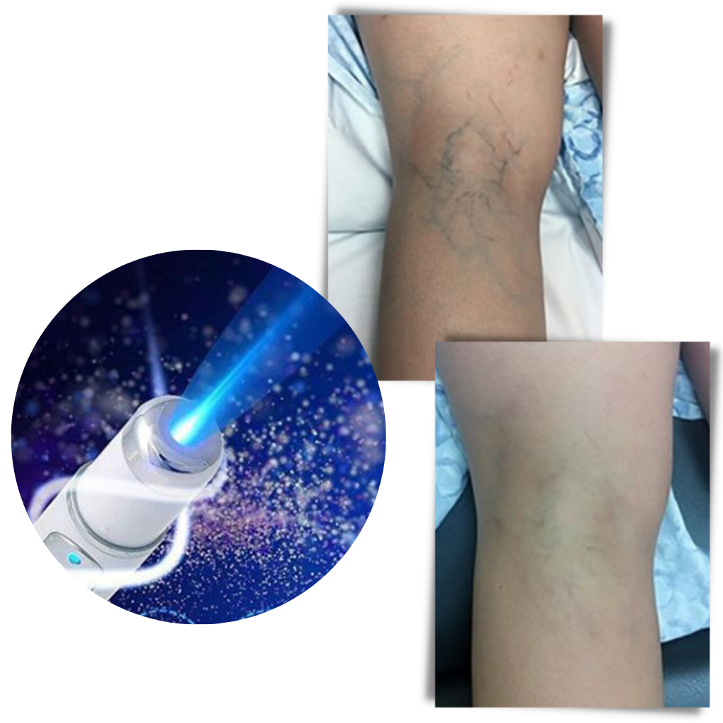 Blauw licht huidtherapie pen