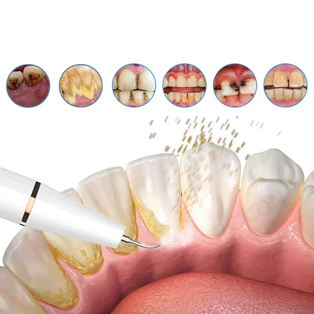 SmilePro Ultrasoon Tandsteenreiniger – Effectieve Plaqueverwijderaar voor Thuis