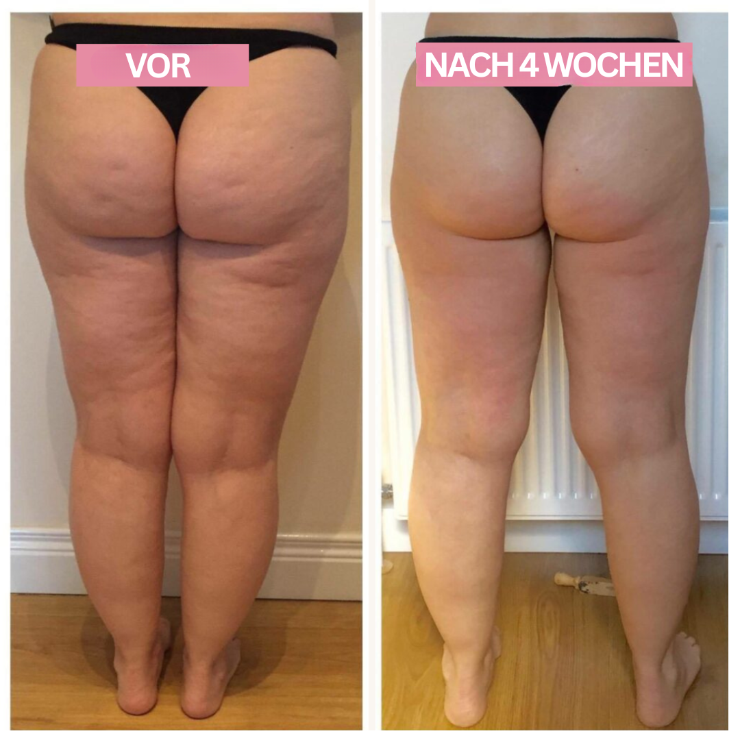 Anti-Celulite-Cupping-Apparaat – SlimCupp